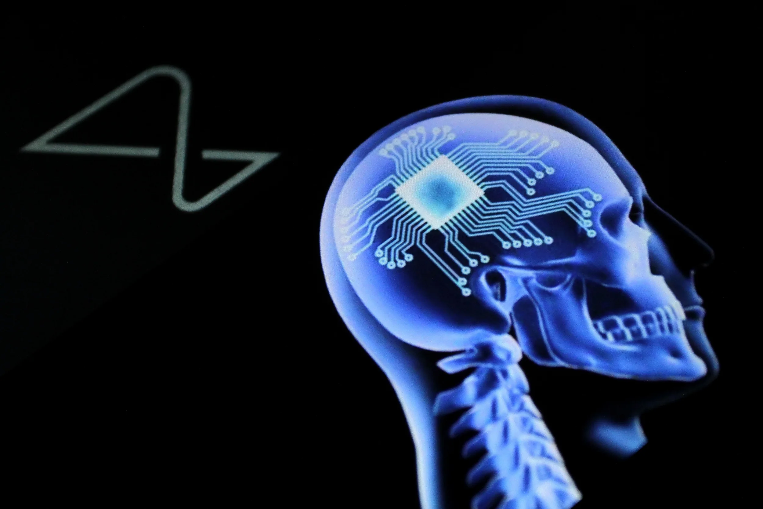 LA CHINE DEVANCE NEURALINK AVEC UNE PUCE CÉRÉBRALE DÉJÀ REMBOURSÉE PAR LA LES ASSURANCES SANTÉ LOCALES