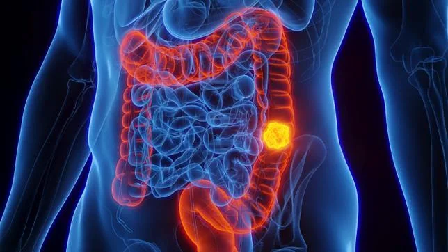 LES TAUX DE CANCER AUGMENTENT PLUS VITE CHEZ LES PERSONNES DE MOINS DE 50 ANS