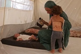 À GAZA, LA HAUSSE DES MALADIES CUTANÉES SYMPTOMATIQUE D’UNE SITUATION SANITAIRE CATASTROPHIQUE