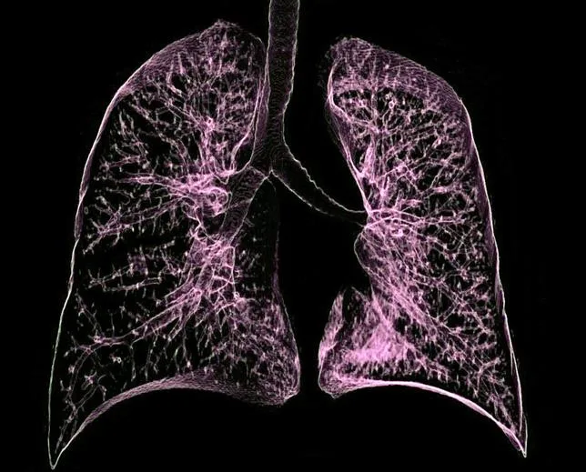 UNE MUTATION GÉNÉTIQUE POURRAIT FAVORISER LE CANCER DU POUMON CHEZ LES NON-FUMEURS